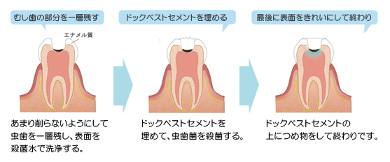ドックスベストの治療イメージ画像